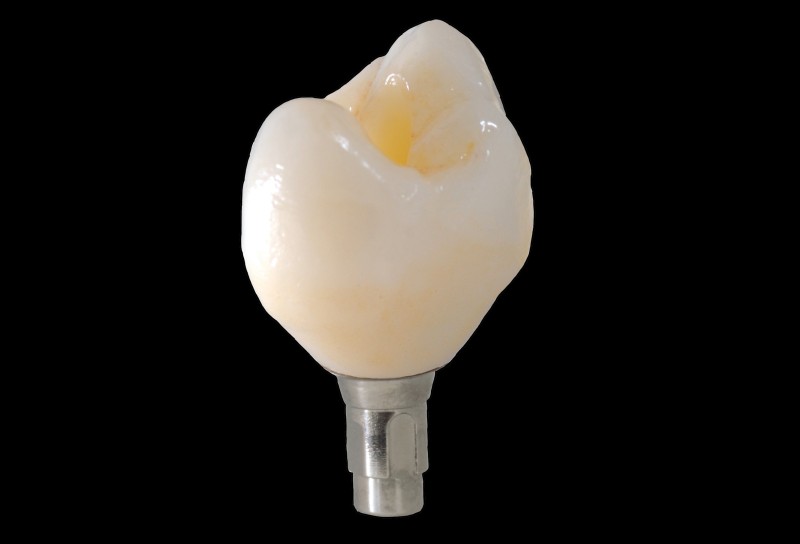 Implant Restorations