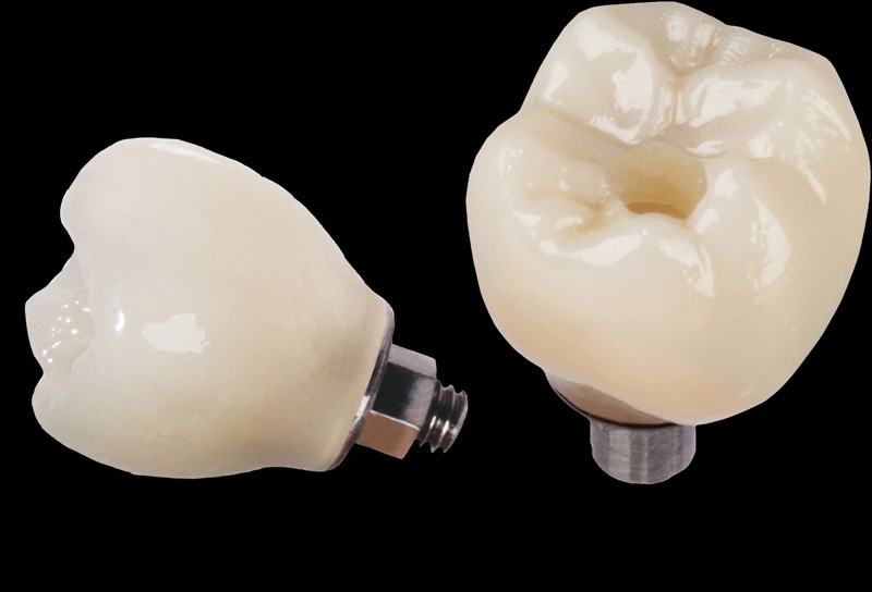 Implant Restorations