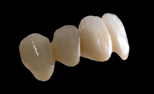 zirconia crown and bridge
