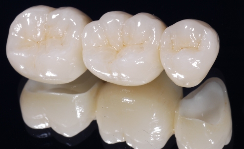 zirconia crown and bridge